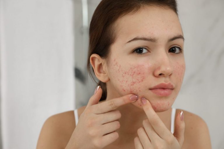 How to Remove Acne Scars Naturally Overnight