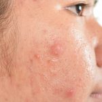 How to Remove Acne Scars Naturally for Oily Skin