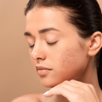 How to Remove Acne Scars Naturally in a Week