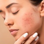 Indian Home Remedies for Acne Scars