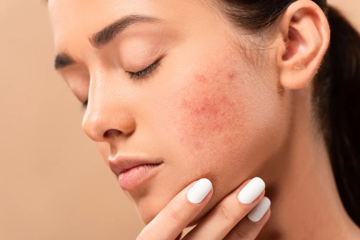 Indian Home Remedies for Acne Scars