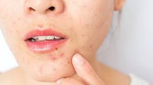 how to remove pimple marks in one day home remedies